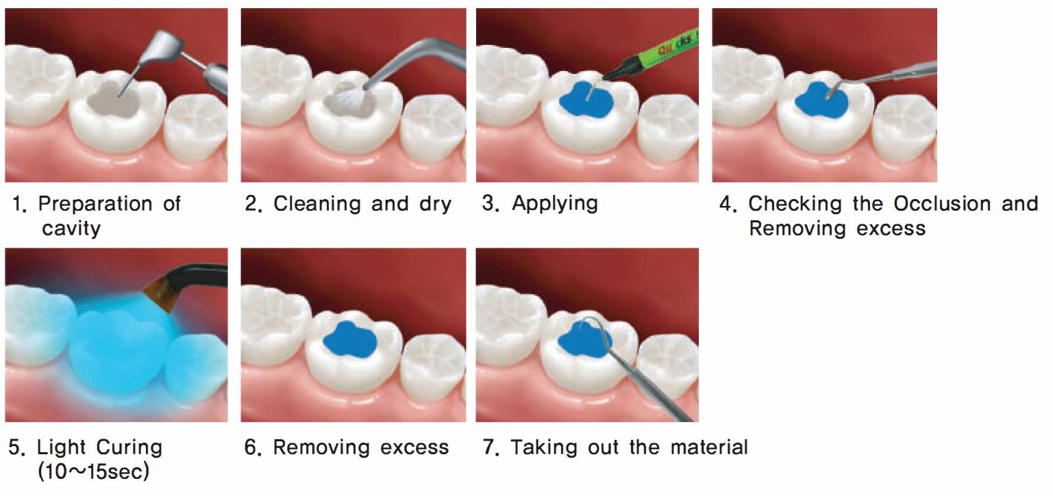 DENTKIST Quicks Flow | CareDes Sdn. Bhd.